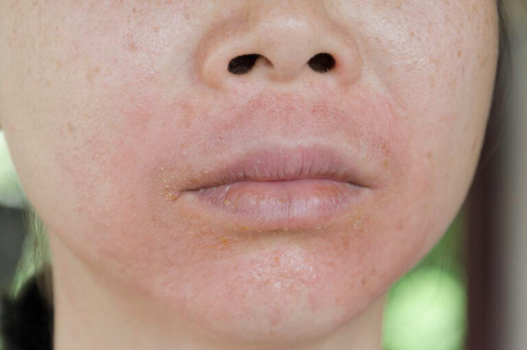 Effective Treatments for Eczema