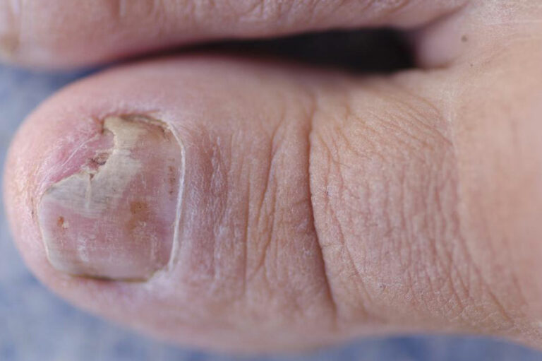 Effective Ways to Treat Toe Fungus