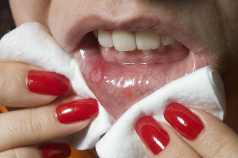 Effective ways to prevent cold sores