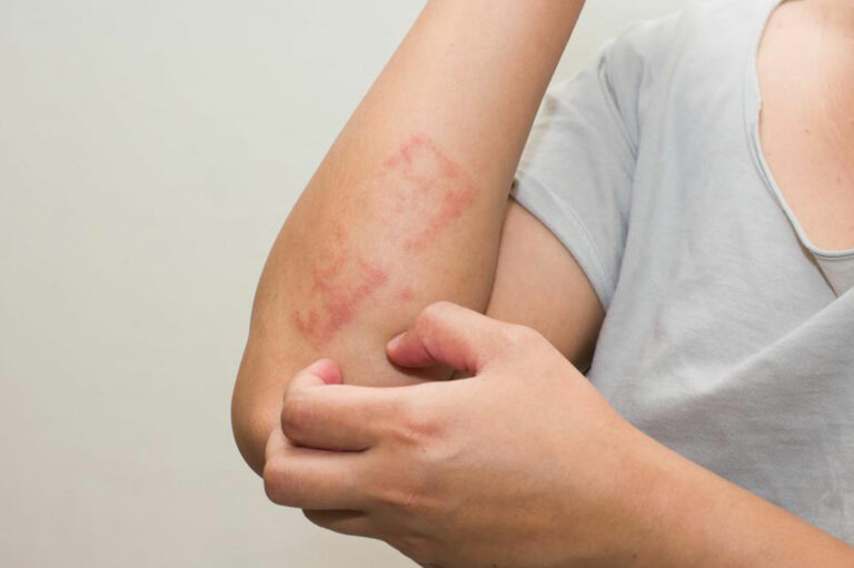 Factors Causing Atopic Dermatitis and Treatments for it