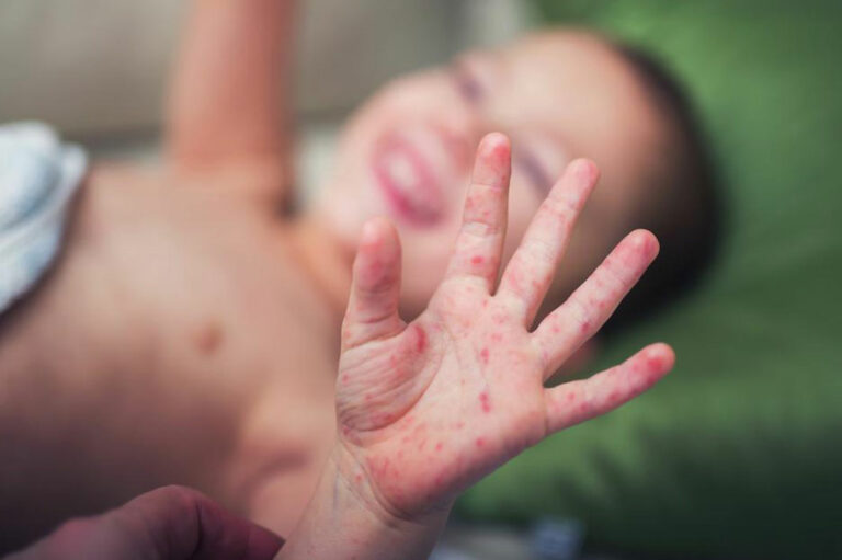 Find the Cure for Baby Eczema with the Right Creams