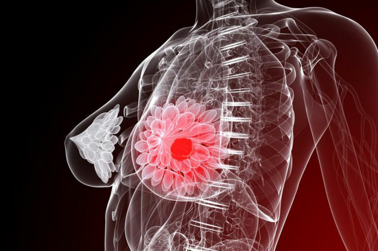 Five things you need to know about breast cancer