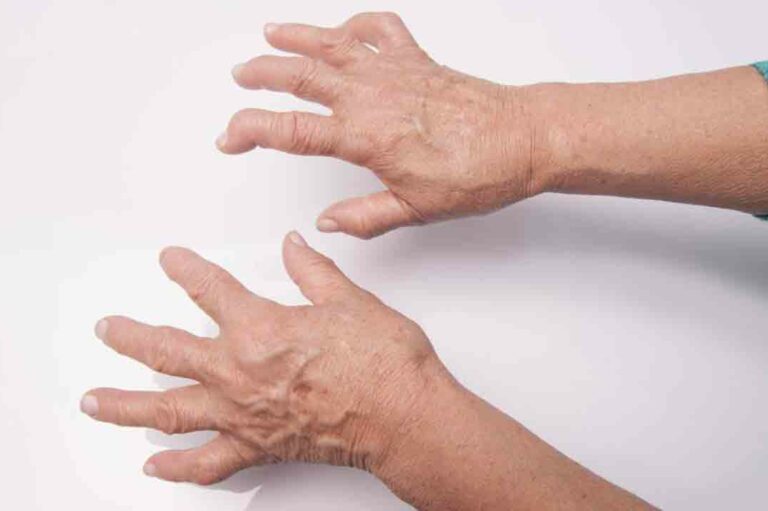 Food Items You Should Avoid When Suffering from Arthritis