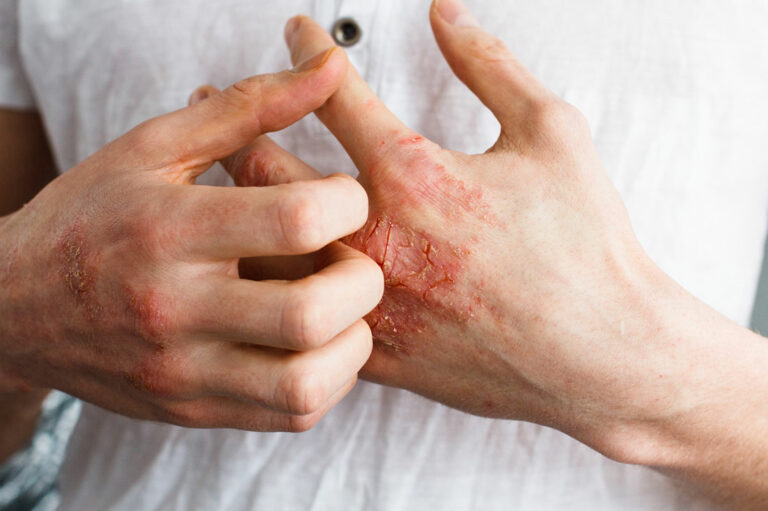 Foods to Eat and Avoid for Patients with Eczema