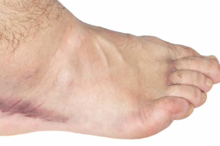 Get Easy Relief from Your Swollen Ankle