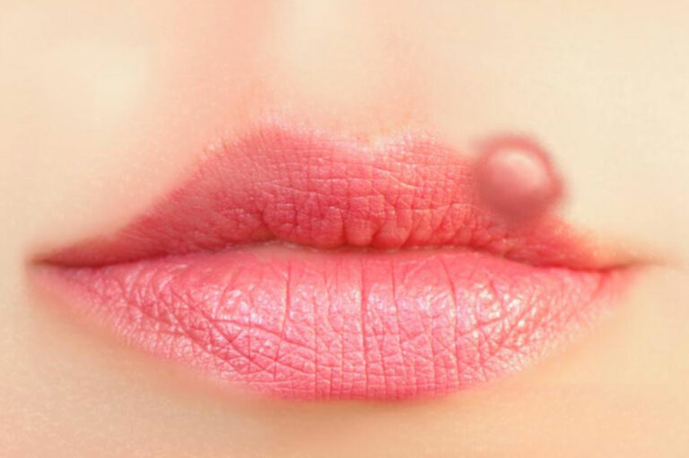 Get Quick Relief from Cold Sores