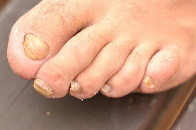 Get Rid of Toenail Fungus Quickly with 6 Home Remedies