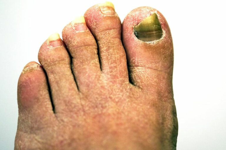 Get Rid of Toenail Fungus With the Right Treatment