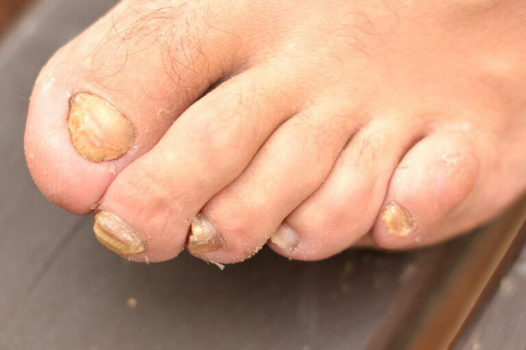 Get rid of toenail fungus with these home remedies