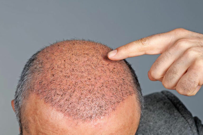 Hair Transplant Cost and Procedure