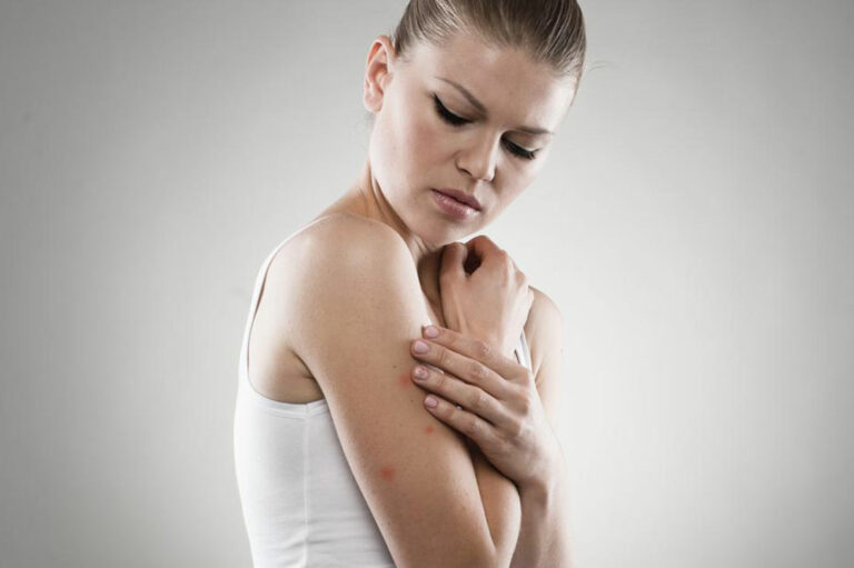 Here Are a Few Things to Know about Eczema Treatments