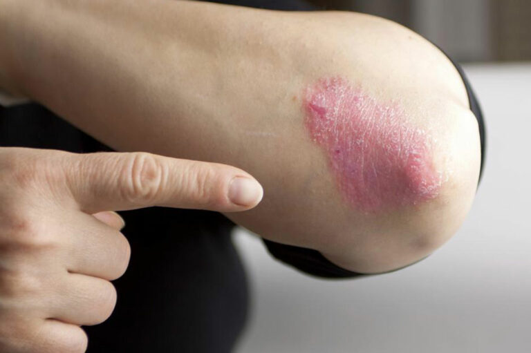 Here Are a Few Things to Know about Psoriasis