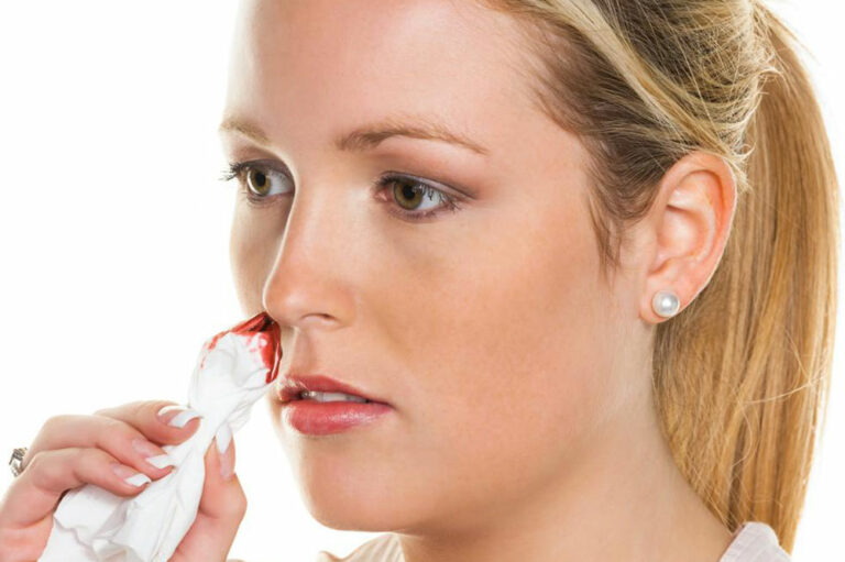 Here are the causes behind nose bleeding