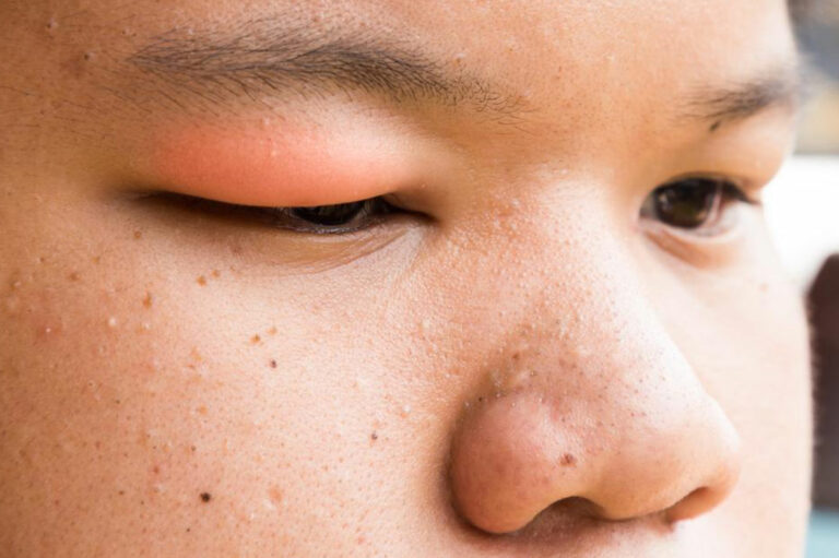 Here&#8217;s How to Get Rid of a Stye With These Simple Steps