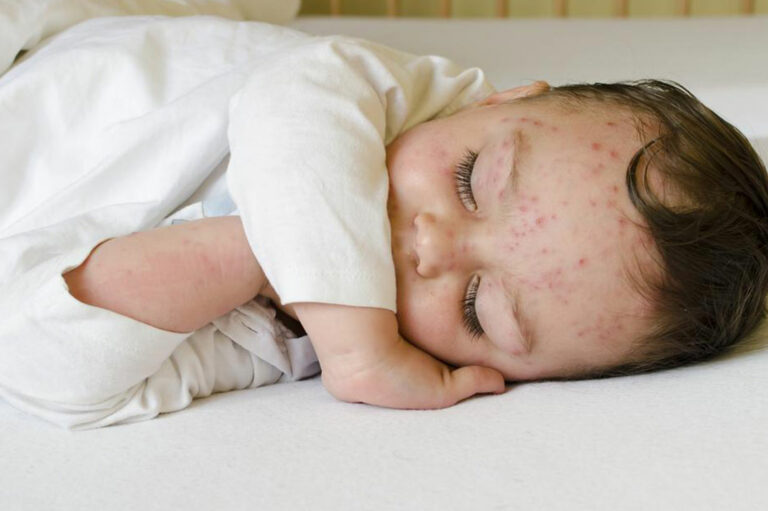 Here&#8217;s how to treat skin rashes in babies