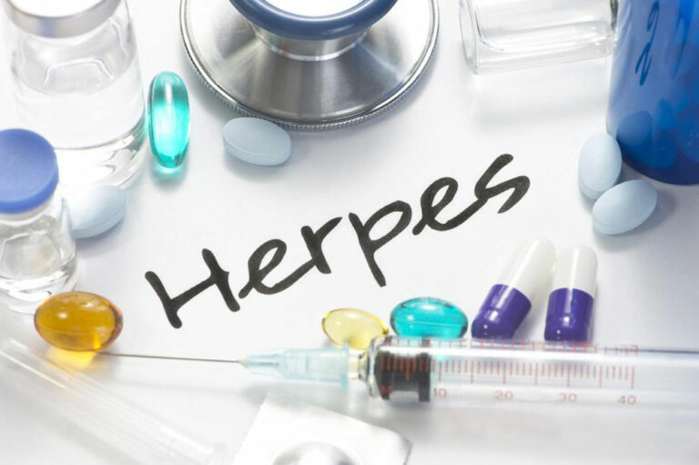 Herpes: Things one should be aware of