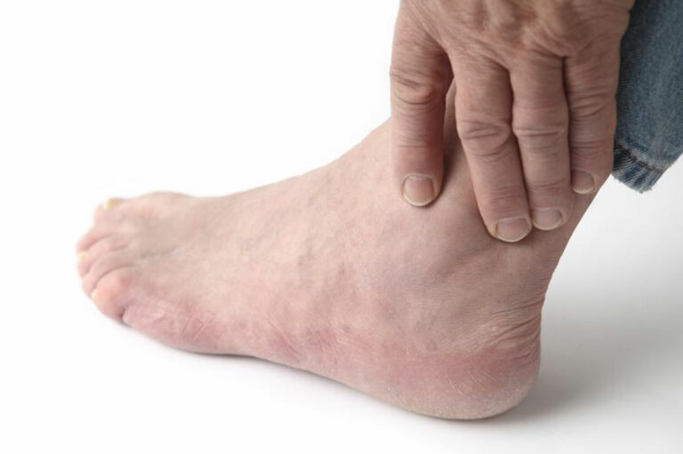 Home treatment for relief from gout foot pain