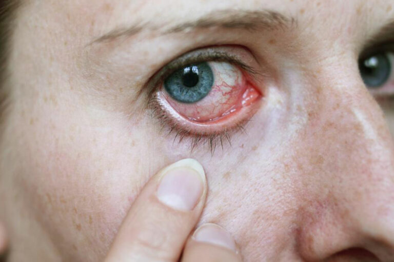 How to Treat Pink Eye with Eye Drops