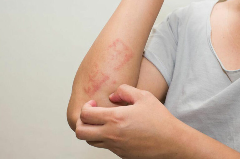 How to identify and treat poison ivy rash with daily use products