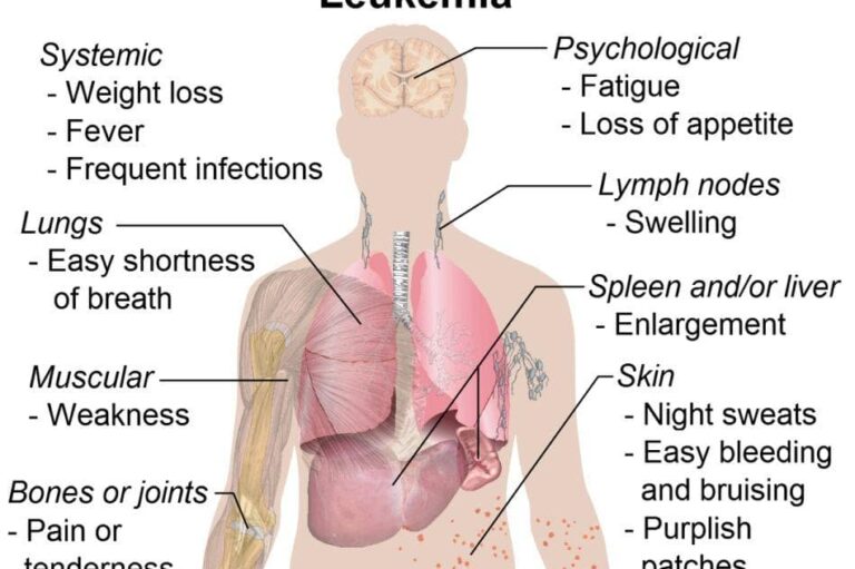 Is your Body Telling You About these Leukaemia Symptoms?