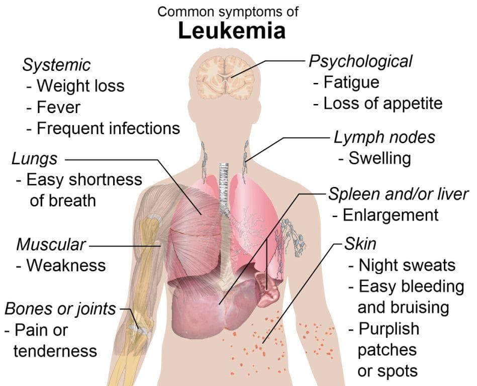 Is your Body Telling You About these Leukaemia Symptoms?