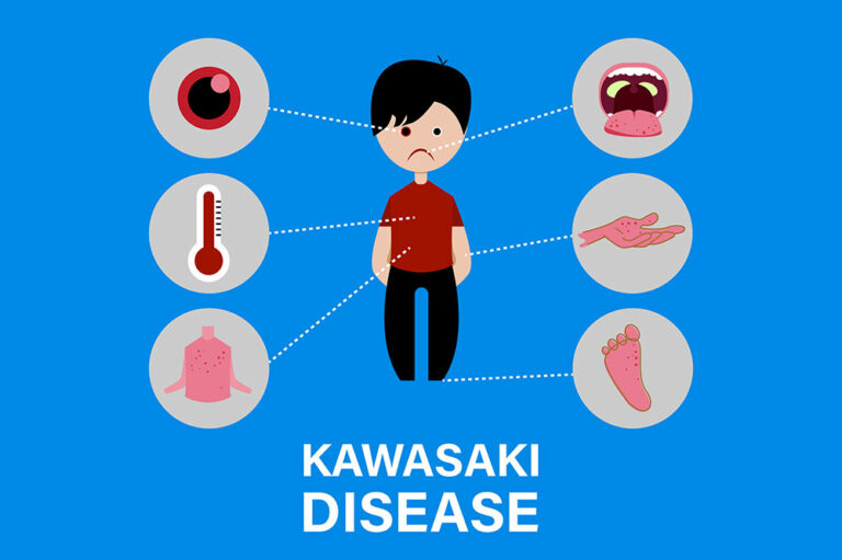 Kawasaki disease &#8211; causes and symptoms