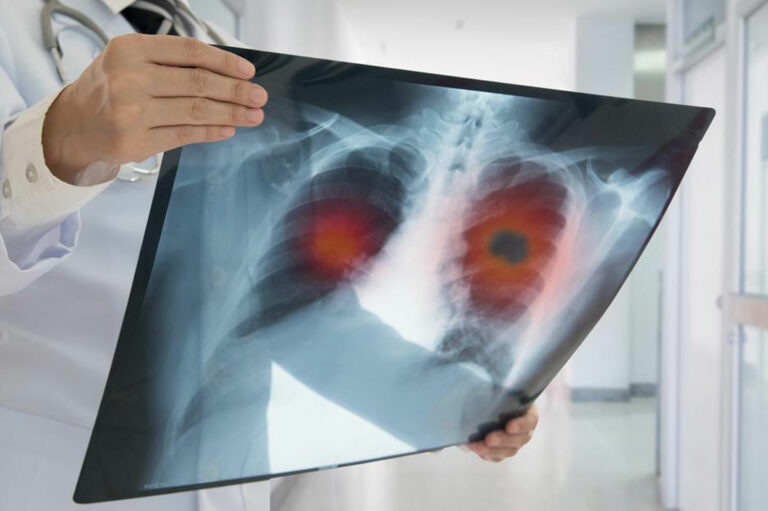 Know the causes, symptoms, and treatment of non-small cell lung cancer