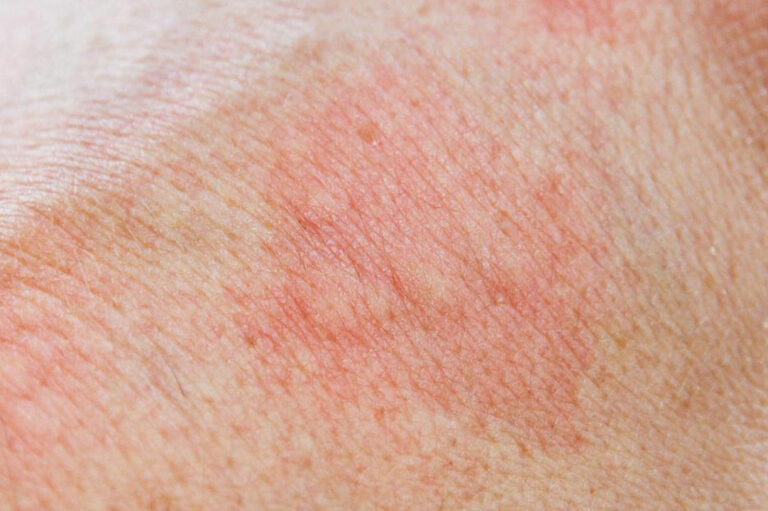 Know about the 5 Types of Skin Rashes