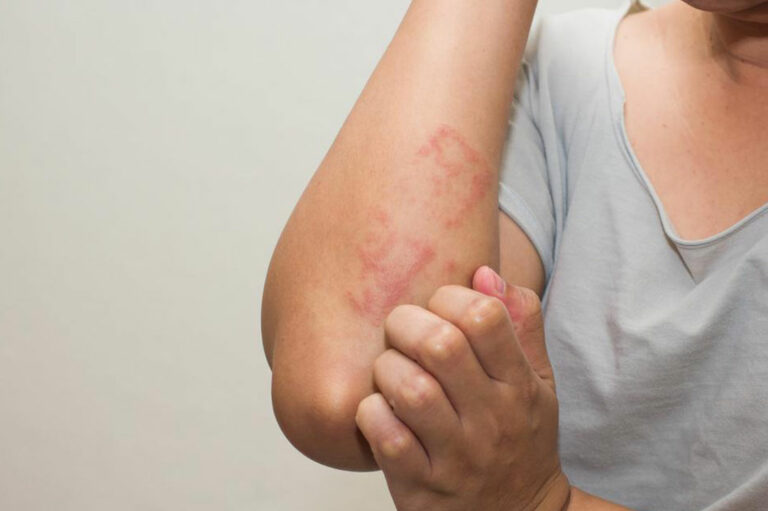 Lupus Skin Rash &#8211; Symptoms and Treatment