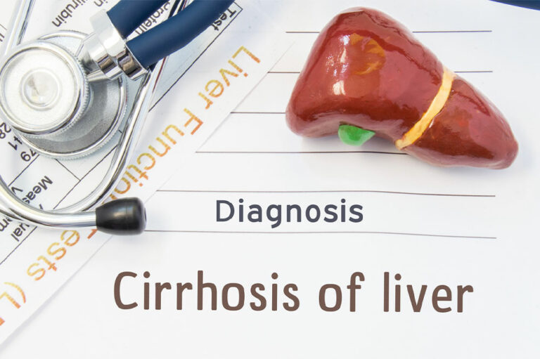 Liver Cirrhosis &#8211; Its Stages and Prevention