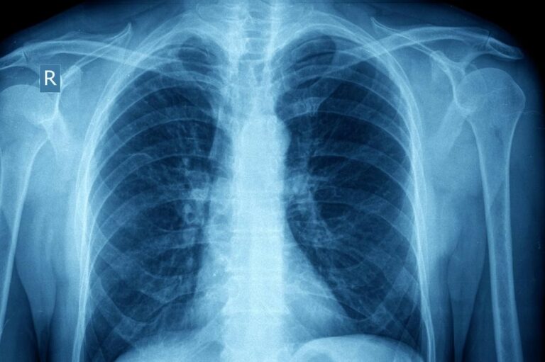 Pathology and Pathophysiology of Asthma