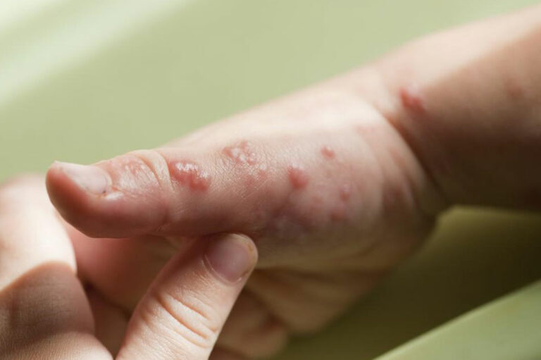 Popular Treatment Options for Shingles