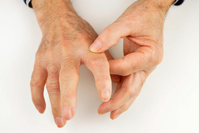 Popular Treatment Options for Rheumatoid Arthritis and Gout