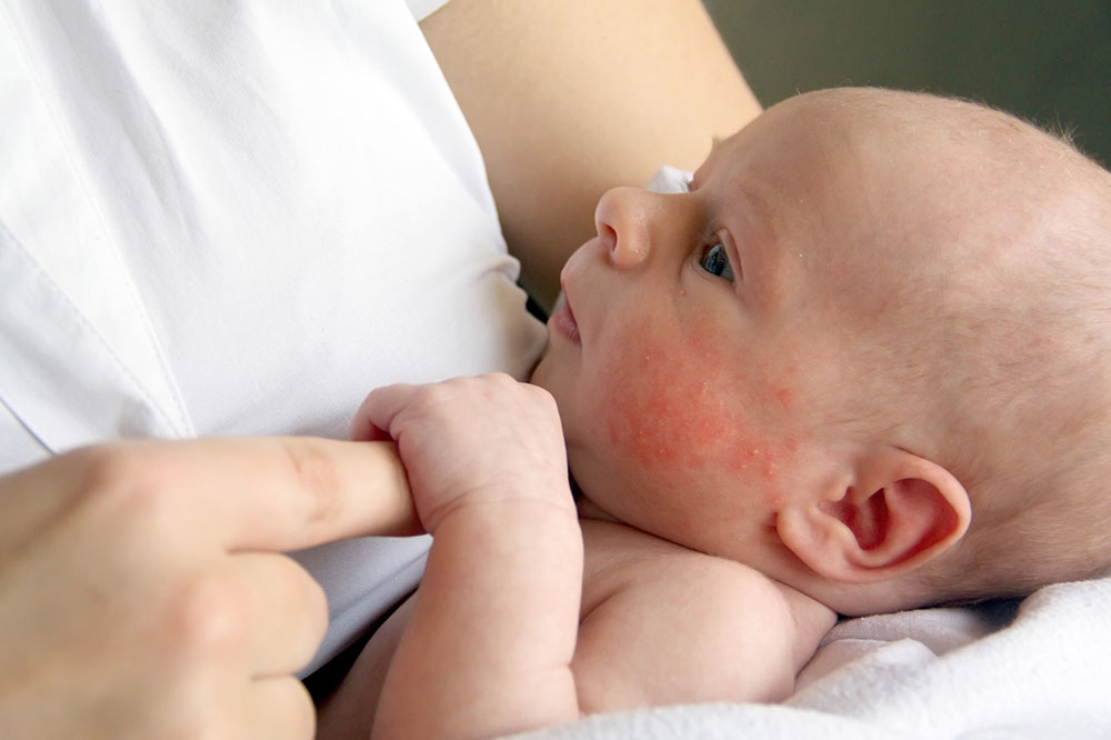 Prevent these infant skin issues to keep your baby’s skin flawless