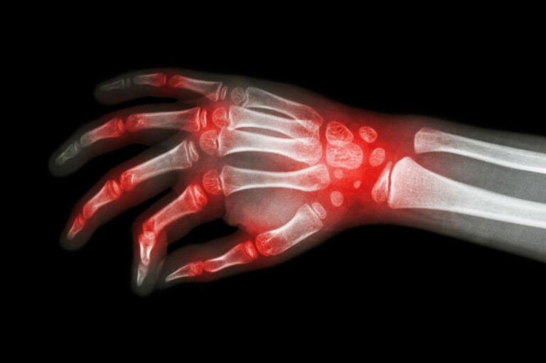 Rheumatoid arthritis and lupus – what makes them similar?