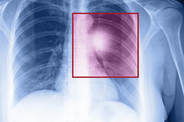 Symptoms and Treatment of Metastatic Lung Cancer