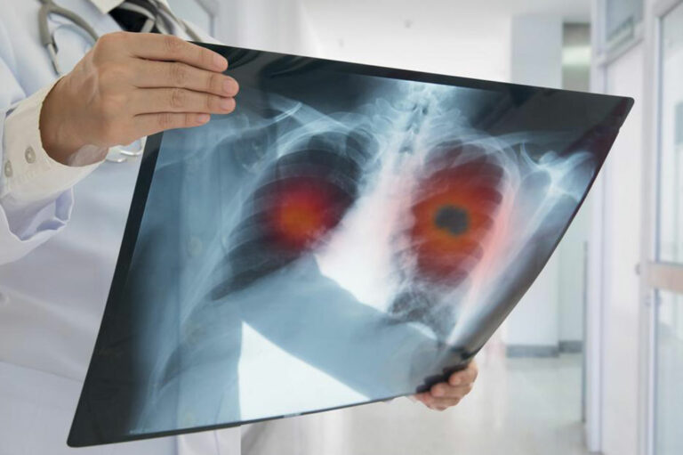 Symptoms and Treatments for Non-Small Cell Lung Cancer