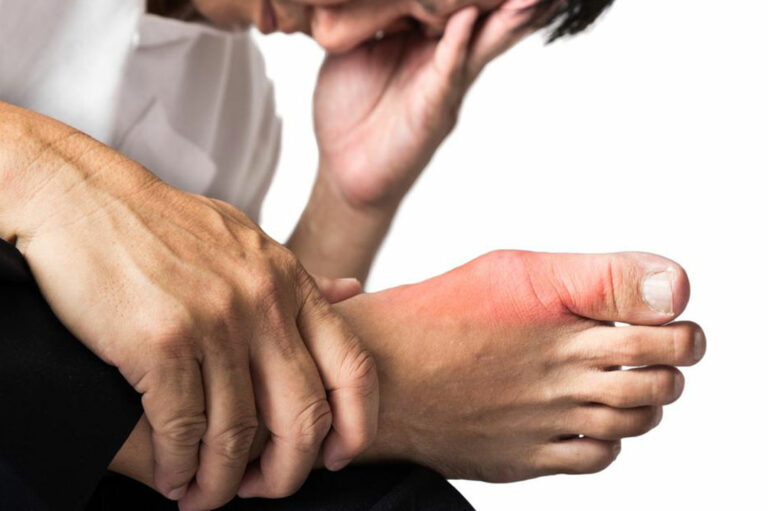 Symptoms and Treatments for Gout