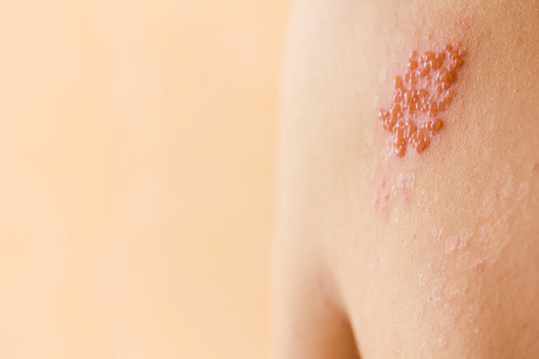 Symptoms and causes of shingles