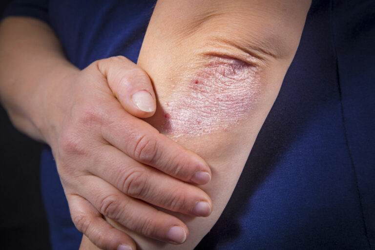 Symptoms and risk factors of psoriasis