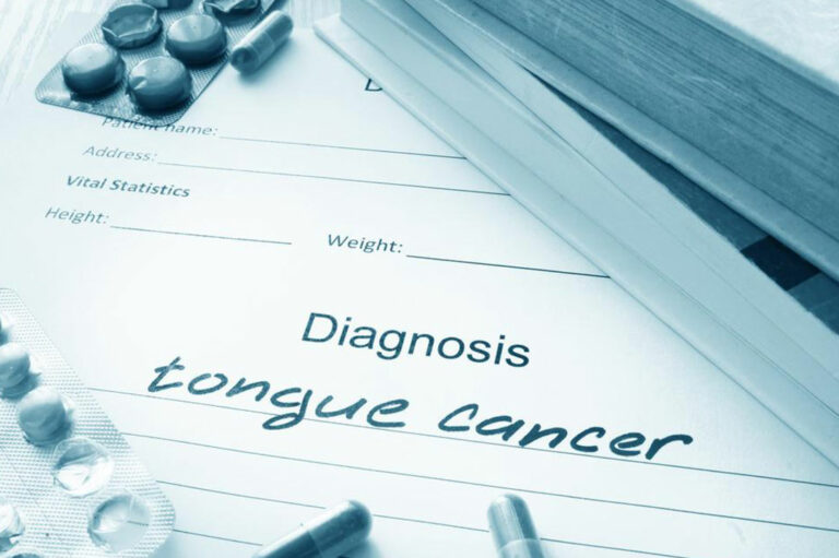 Symptoms of tongue cancer you should not ignore