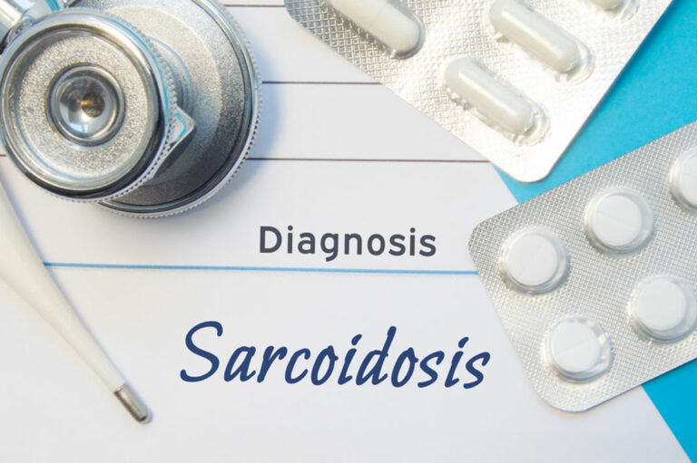 Sarcoidosis risk factors you should know about