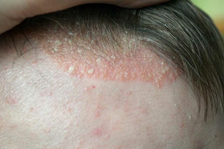 Scalp Psoriasis &#8211; Symptoms to Watch out For