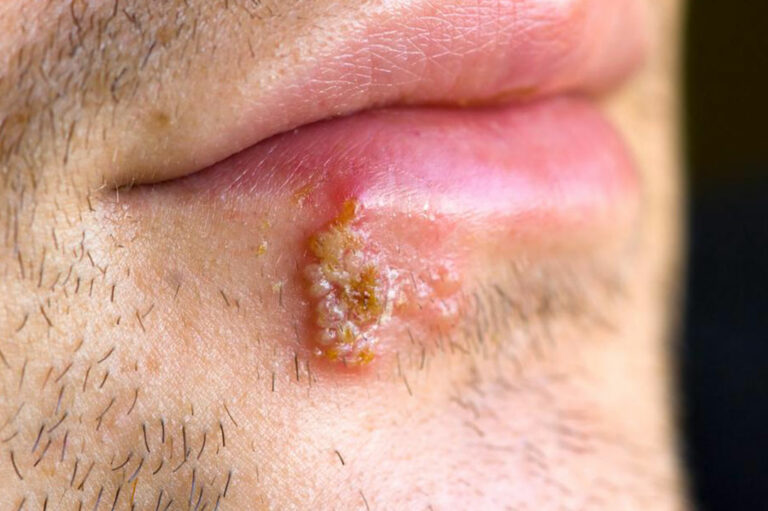 Signs that tell you might have herpes