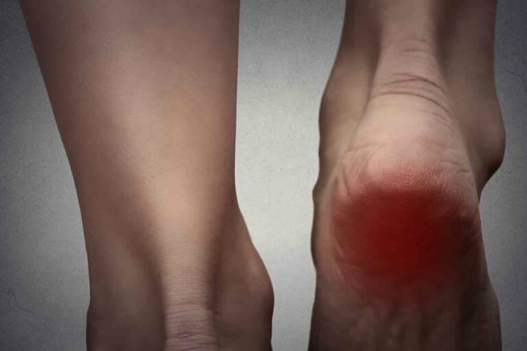 Simple Treatment Options for Gout