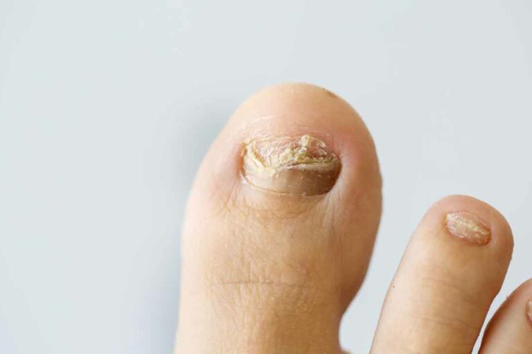 Some tips on how to cure nail fungus