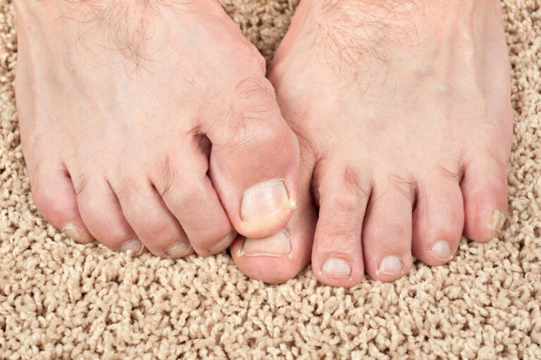 Some Effective Home Remedies for Toenail Fungus