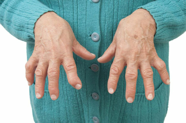 Types of arthritis and ways to deal with them