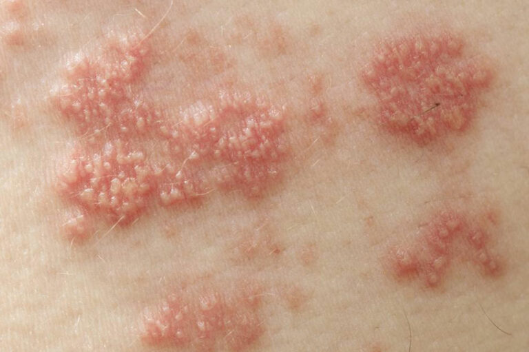 The Treatments for Shingles You Should Know