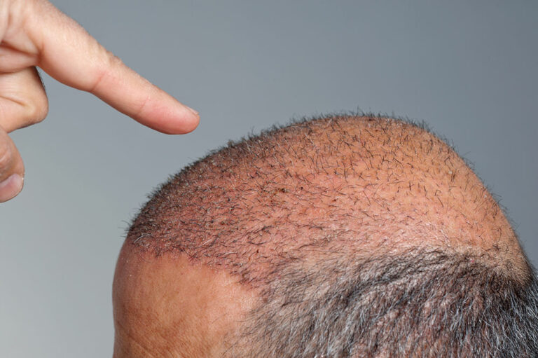 The truth about how much hair transplants cost